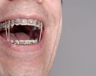 Rubber Bands for Braces  Garcia Orthodontics Miami FL